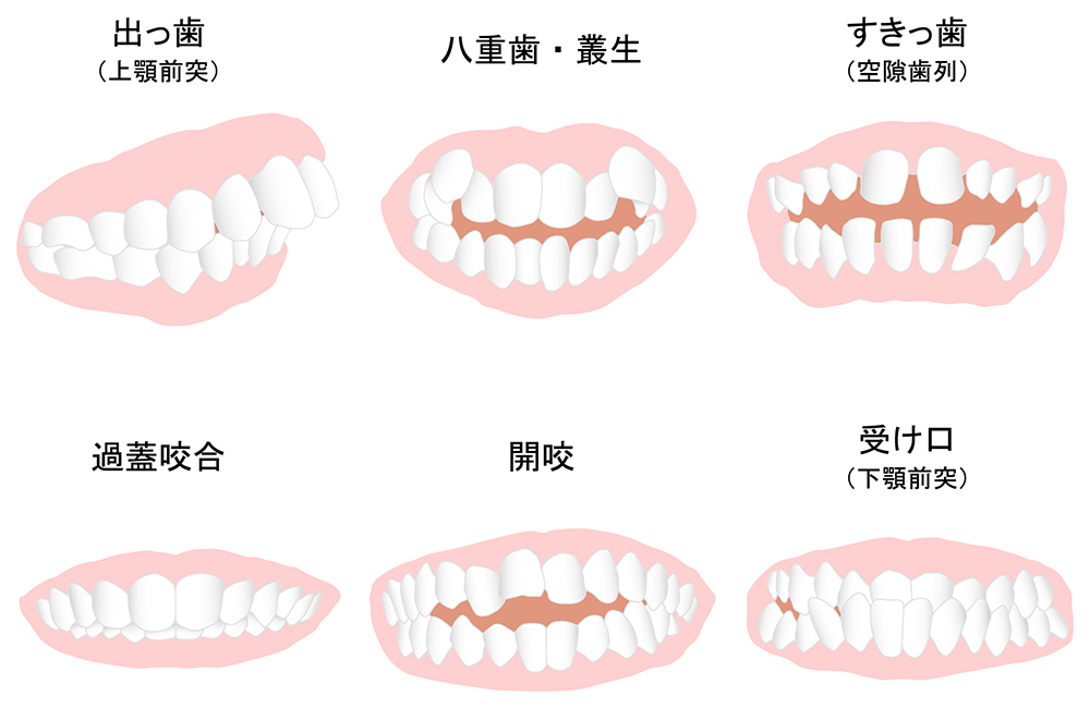 不正咬合の種類